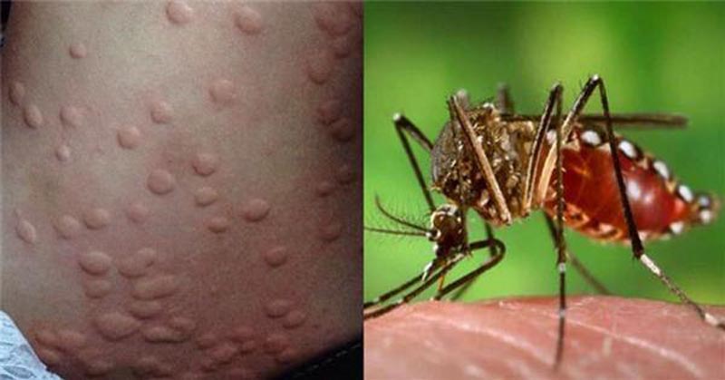 你總是被「蚊子騷擾」嗎科學家終於找出「原因」了．．．但是這結果真的令人很崩潰呀~