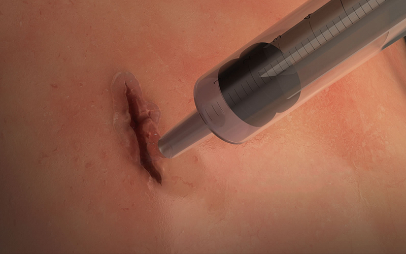不必動手術縫線  「超級膠水」只需60秒就能復原傷口，連器官也可以適用整個超猛  （影）